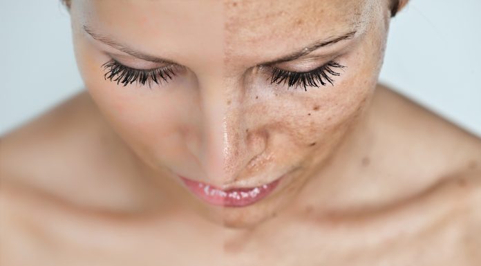 Intervju dr. Sandi Luft: s fotopomlajevanjem nad kožne nepravilnosti