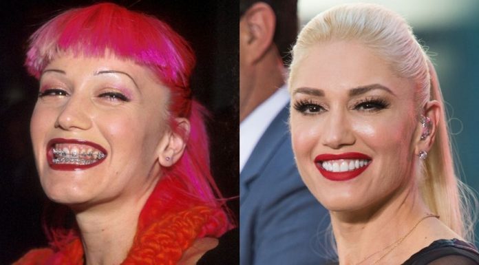 Neverjetne spremembe nasmehov zvezdnikov