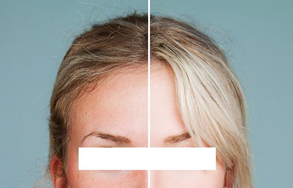 Rosacea, ta spregledana, a ozdravljiva nadloga