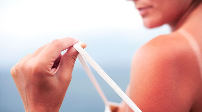 To so 3 živila, s katerimi si lahko pomagate blažiti sončne opekline