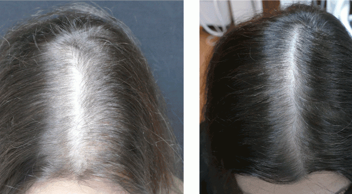 Kaj povzroča izpadanje las in kako si lahko učinkovito pomagamo?