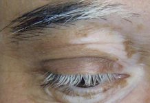 Vitiligo: kaj je, simptomi in zdravljenje