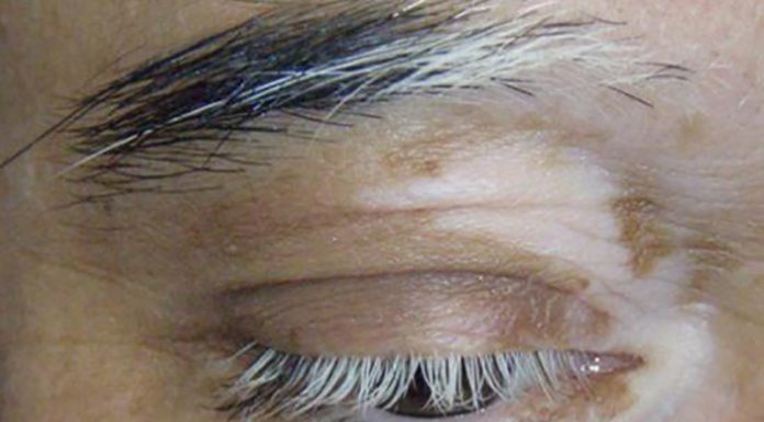 Vitiligo: kaj je, simptomi in zdravljenje