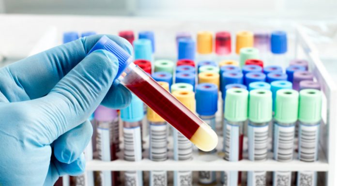 Koronavirus: če imate krvno skupino 0, ste najbolj odporni; če A, najbolj ogroženi