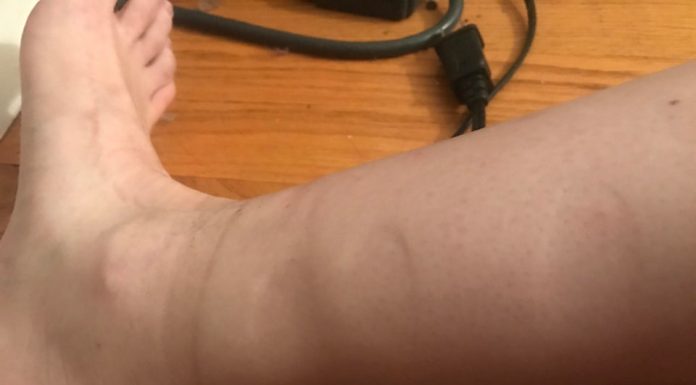 Zdravstvena stanja, ki jih razkrivajo odtisi nogavic na vaših nogah