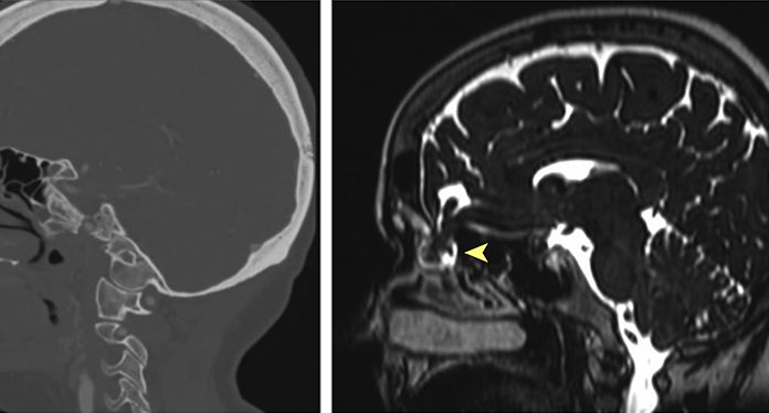 Test za koronavirus predrl možgansko pregrado in puščati je začela možganska tekočina