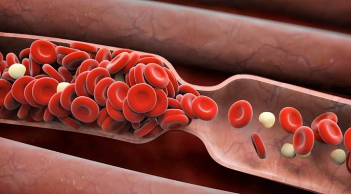 Naravna sredstva za redčenje krvi