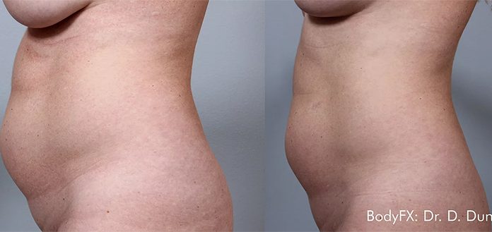 Spoznajte BodyFX® – klinično dokazno tehniko za neinvazivno zmanjšanje maščobnega tkiva