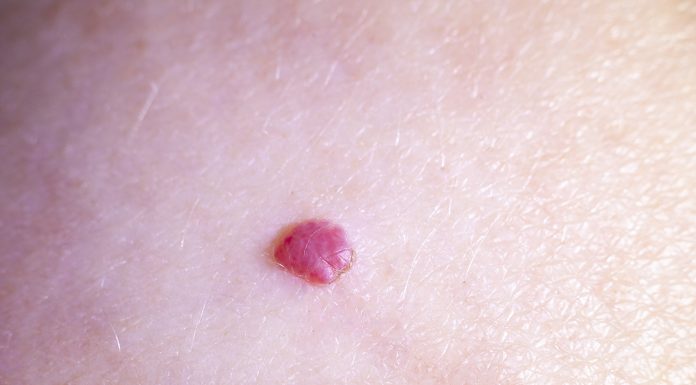 Kaj so te rdeče pike na vaši koži?