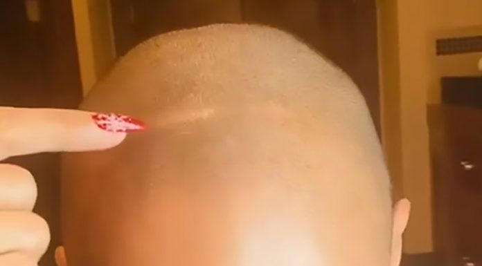 Zvezdnica zaradi avtoimunske bolezni izgublja lase, a pravi, da se je sprijaznila