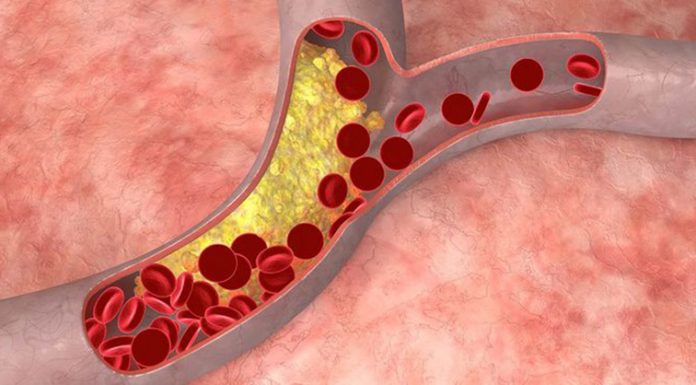 Zgodba o holesterolu: (še ena) velika prevara farmacevtske industrije