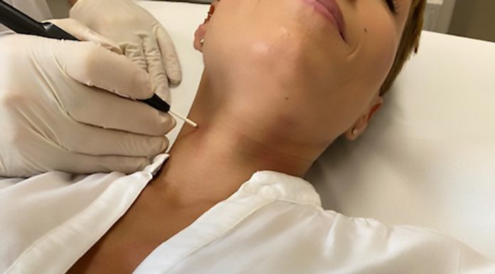 Odstranjevanje benignih kožnih izrastkov