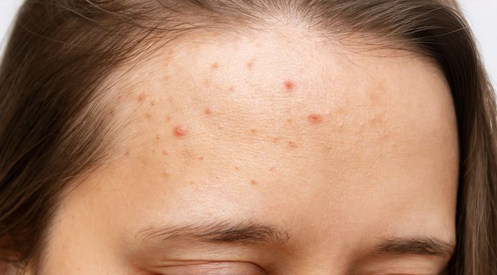 Akne na teh delih telesa povedo veliko o vaših življenjskih navadah