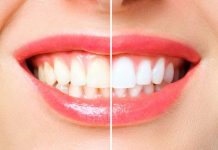 Naj poletna kombinacija: Bel in zdrav nasmeh