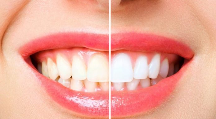 Naj poletna kombinacija: Bel in zdrav nasmeh