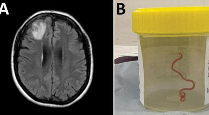 Zdravniki iz glave ženske izvlekli še živega črva; vsi so bili šokirani