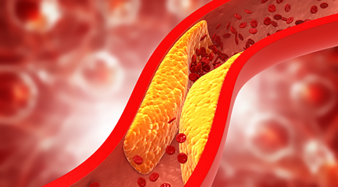 Študija: Ljudje z visokim holesterolom živijo (naj)dlje
