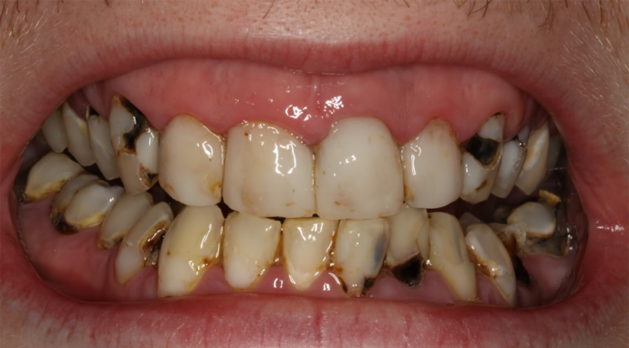 Kako je rastlinska prehrana privedla do propada(nja) človeškega zobovja