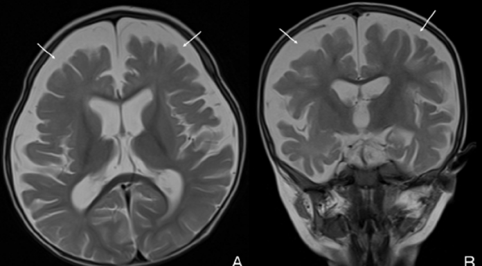 Možganska atrofija pri dojenčku vegetarijanske matere zaradi pomanjkanja vitamina B12