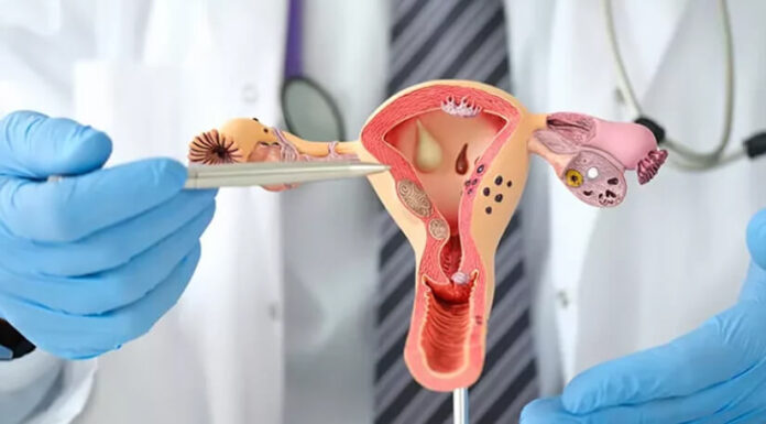 Kako vam lahko inozitol pomaga pri policističnih jajčnikih (PCOS)?