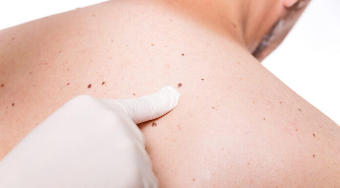 Študija: Kožni rak najbolj pogost pri belih homoseksualnih moških