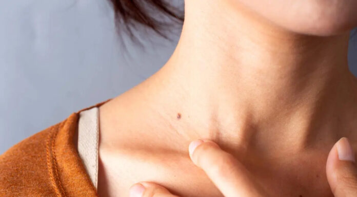 Ta vitamin pomaga pri preprečevanju več vrst kožnega raka