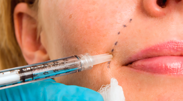 Strašljivo: MRI obraza 33-letne ženske razkril, kam vse potujejo obrazna polnila