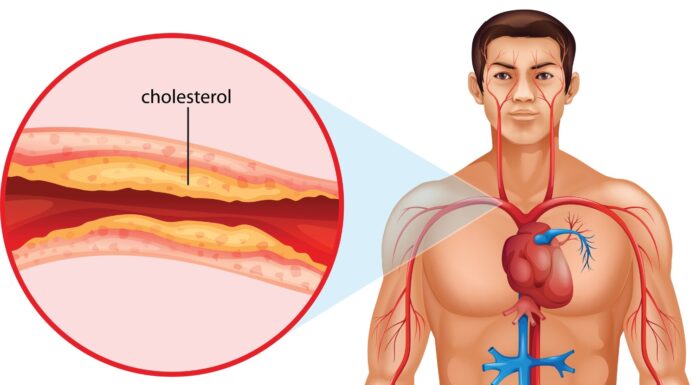 Razbijamo mite: “dober” in “slab” holesterol ne obstaja
