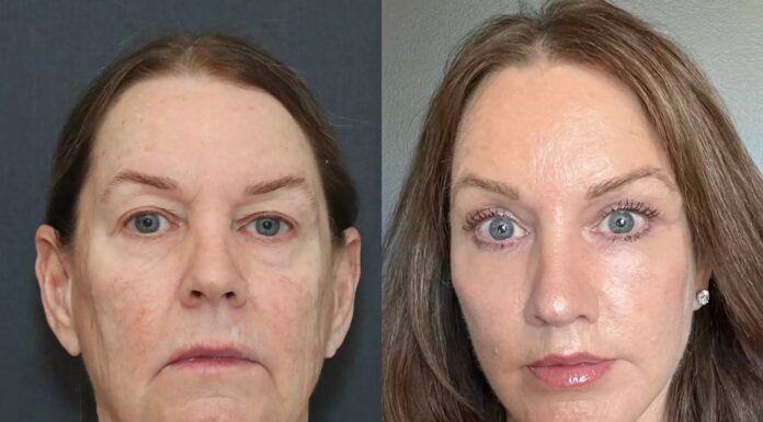 66-letnica shujšala 50 kg in si naredila šokanten lifting obraza, da so mislili, da gre za prevaro