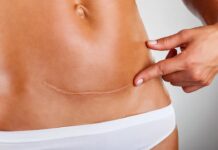 Čudež v Mehiki: kako si je ženska sama izvedla carski rez – in preživela