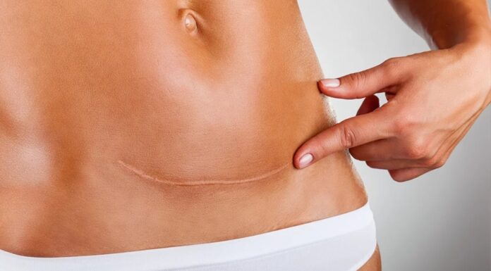 Čudež v Mehiki: kako si je ženska sama izvedla carski rez – in preživela