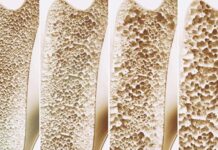 “Zdravila” za hujšanje zmanjšajo tudi mišično in kostno maso