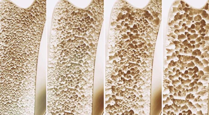 “Zdravila” za hujšanje zmanjšajo tudi mišično in kostno maso