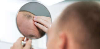 Prihaja serum, ki bo rešil plešavost v 20 dneh?