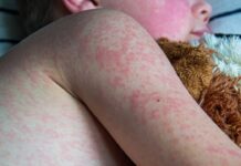 Ošpice v otroški dobi: odlična zaščita pred rakavimi obolenji