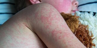 Ošpice v otroški dobi: odlična zaščita pred rakavimi obolenji