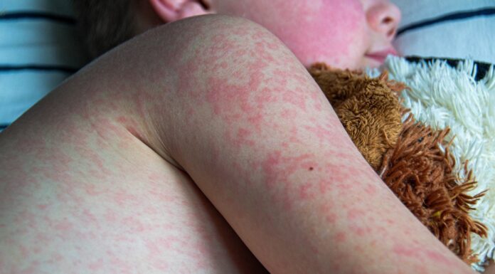 Ošpice v otroški dobi: odlična zaščita pred rakavimi obolenji