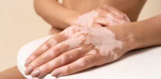 Konec skrivanja: zdravilo za vitiligo je tu